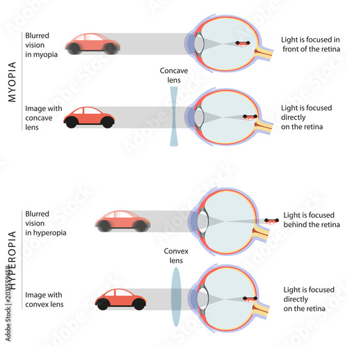Difference Between Myopia and Hyperopia