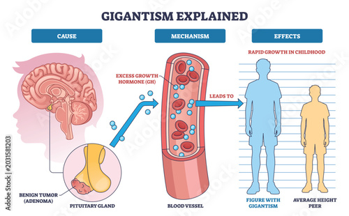 Tableau sur toile Gigantism explained overview shows pituitary tumor causing excess growth hormone in blood and rapid height increase, brain, blood vessel, tall child compared to peer