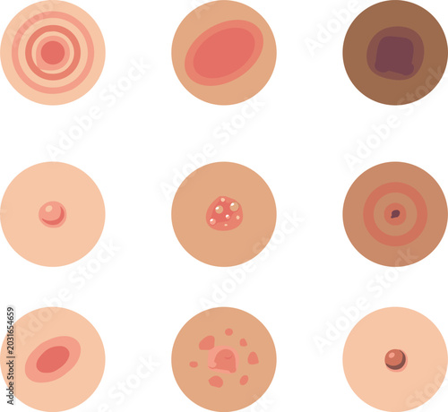 Photos Lyme Disease Rash Types and Tick Bite Symptoms Icon Set Explaining Erythema Migr