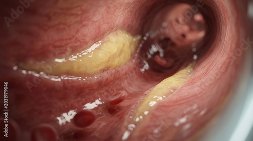 Atherosclerosis inside artery with yellow plaque buildup and red blood cells showing narrowing of blood vessel causing potential heart disease and vascular problems
