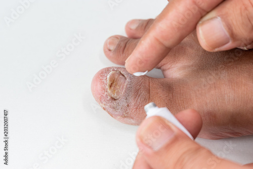Removing Debris from Damaged Toenail Surface Area