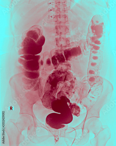 Barium enema X-ray showing a colon polyp in the descending colon, medical imaging of colorectal neoplasm