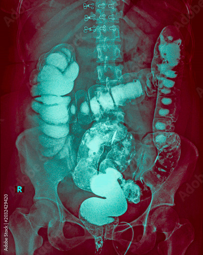 Barium enema X-ray showing a colon polyp in the descending colon, medical imaging of colorectal neoplasm