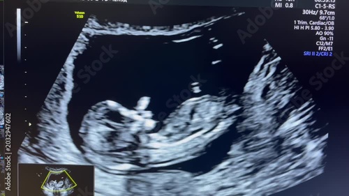 Ultrasound images depict the continuous development of a fetus in the first trimester, showcasing anatomical features and the gradual progression of the fetus within the womb