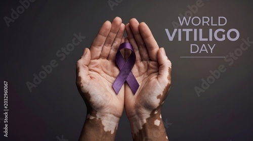 Hands with vitiligo holding purple ribbon for world vitiligo day awareness