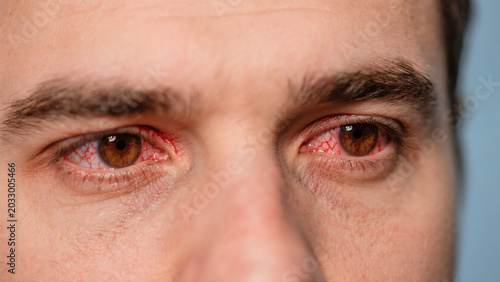 Keratitis is a common inflammatory eye disease that affects the cornea, often causing redness, soreness, blurred vision and eye irritation. Caused by bacterial, viral or fungal infections and external