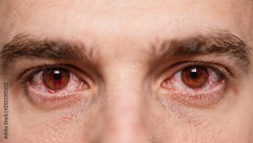 Keratitis is a common inflammatory eye disease that affects the cornea, often causing redness, soreness, blurred vision and eye irritation. Caused by bacterial, viral or fungal infections and external