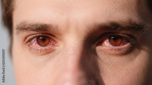 Keratitis is a common inflammatory eye disease that affects the cornea, often causing redness, soreness, blurred vision and eye irritation. Caused by bacterial, viral or fungal infections and external
