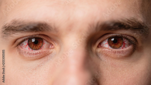 Keratitis is a common inflammatory eye disease that affects the cornea, often causing redness, soreness, blurred vision and eye irritation. Caused by bacterial, viral or fungal infections and external