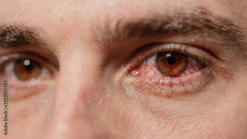 Keratitis is a common inflammatory eye disease that affects the cornea, often causing redness, soreness, blurred vision and eye irritation. Caused by bacterial, viral or fungal infections and external
