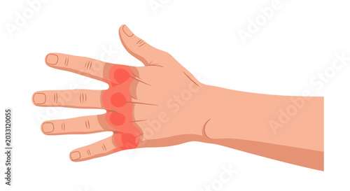 Illustration of a hand showing arthritis symptoms with red swelling on joints, depicted on a white background