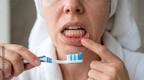 Close-up of a woman pointing to her inflamed gums while holding a toothbrush