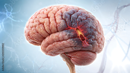 Human brain showing signs of stroke or brain hemorrhage with damaged tissue brain injury blood clot brain damage medical illustration brain stem brain attack brain scan