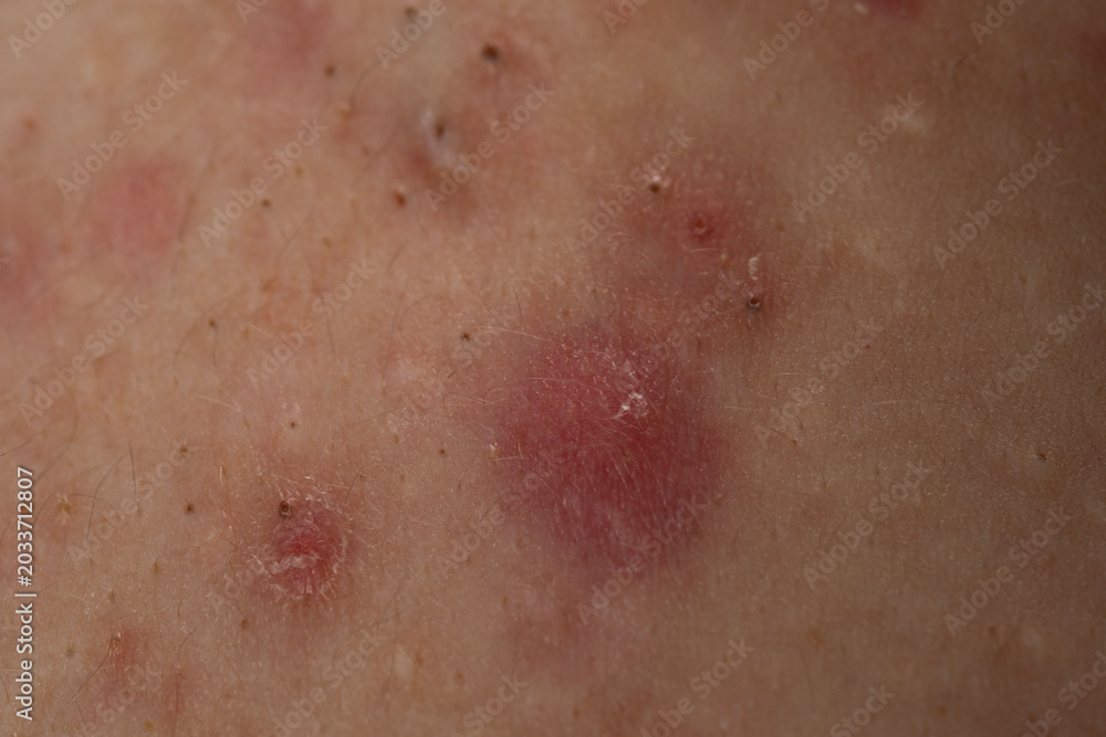 Fototapeta premium Macro shot of skin irritation with acne. Skin problem background with infected bumps and acne. Acne on skin closeup photo. Detailed skin with acne.