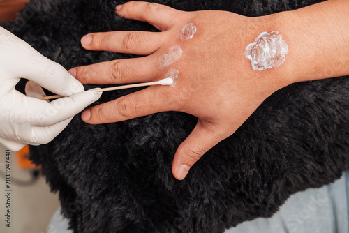 Εκτύπωση καμβά Closeup of topical ointment being applied to treated keloid scars on a hand after a fractional carbon laser procedure at an esthetic clinic