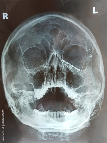 X-RAY of human skull with fractures of eye area and reposition by metal implants