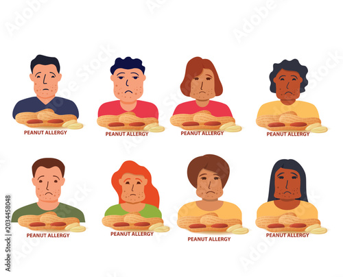 Nut allergy symptoms problem .Swollen man character.Allergic reaction to peanuts.Flat illustration vector.Isolated on a white background.