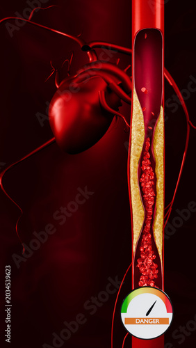 Obraz na plátně Blocked artery with excessive cholesterol accumulation illustrating impaired blood circulation, oxygen deficiency, and elevated risk of cardiovascular complications and stroke