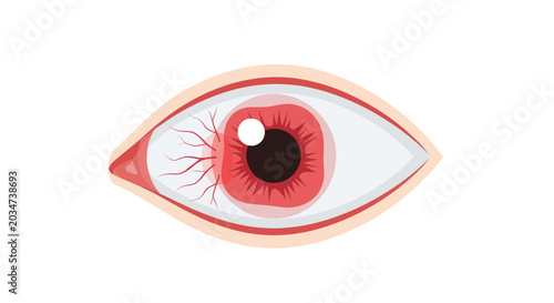Tableau sur toile Red, Irritated Eye with Bloodshot Sclera and Dilated Pupil