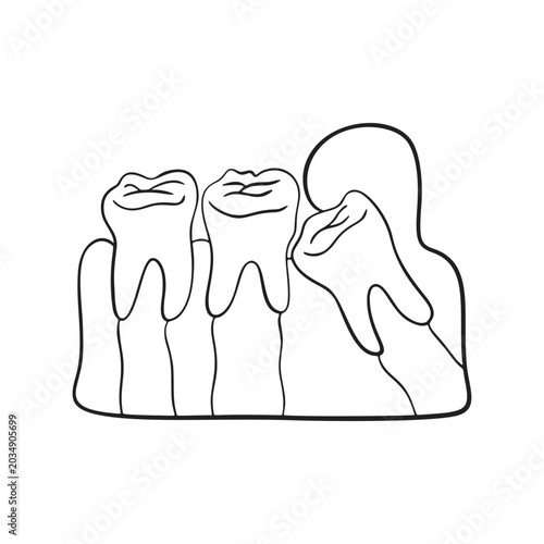 Impacted wisdom tooth Illustration