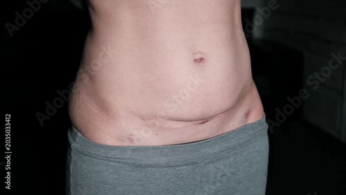 Fresh medical scars on female abdomen after laparoscopic surgery. Stretch marks on light caucasian skin after cesarean section on dark background. Body Lymphatic edema. Maternity concept. Front view.