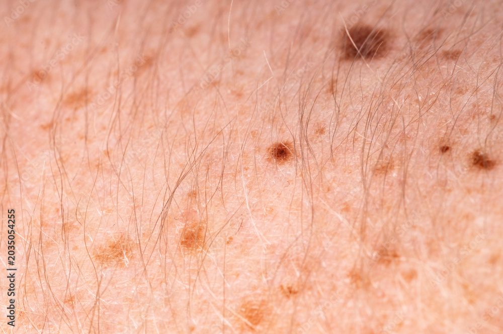 Fototapeta premium Suspicious mole close up on human skin, skin cancer awareness and dermatology concept
