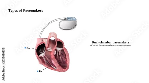 3D Animation of Types of Pacemakers, Cross-Section Heart Anatomy Diagram, Biventricular Cardiac Pacing Device, Medical Resynchronization Therapy Healthcare Illustration