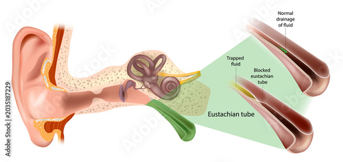 Cross Section Medical Illustration of Ear Anatomy with Blocked Eustachian Tube and Otitis Media Explanation. Eustachian Tube Dysfunction, Trapped Fluid. Normal and Blocked Eustachian Tube 