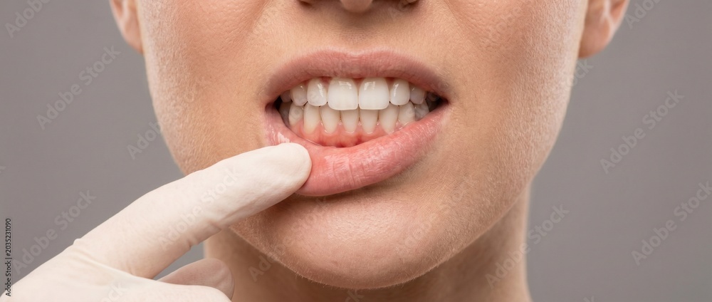 Naklejka premium Close-up of dentist hand in medical glove pulling down patient's lower lip to examine teeth and gums. Dental health, gingivitis, and oral hygiene concept