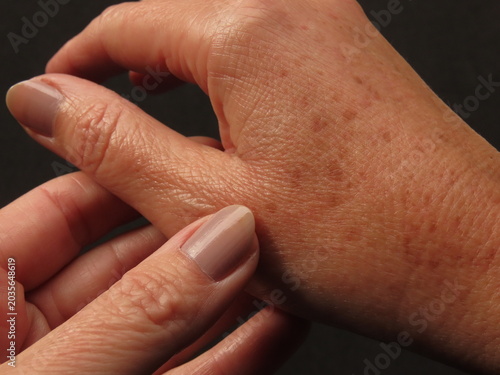 Closeup of woman hand with dark spots on black background. Hyperpigmentation on a woman in her forties hands.