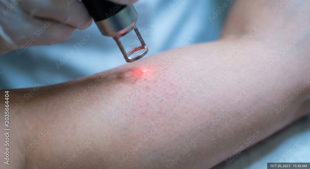 Fototapeta premium Close up of laser device emitting red light pulse for skin treatment or hair removal on arm.