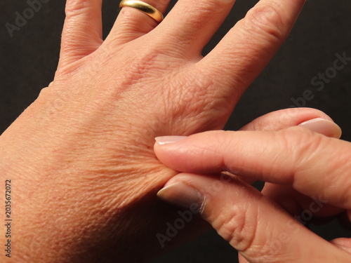 Closeup of woman hands with dry, dehydrated skin and loss of elasticity. Hands of a woman in her forties.