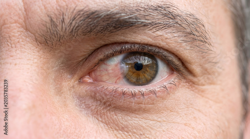 Man’s eye with pterygium tissue and irritation