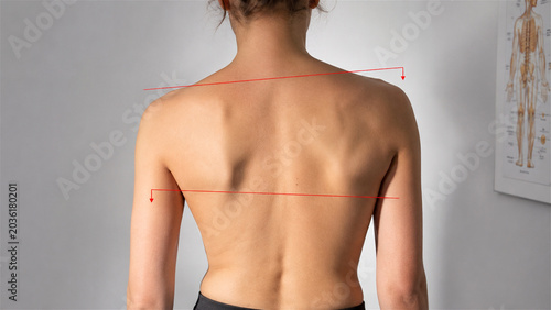woman with scoliosis and uneven shoulder posture. Orthopedic medical examination of spine curvature in doctor office. Health assessment for diagnosis of back health problem condition