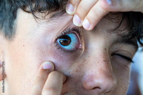 Close-up of a human eye being held open by fingers, revealing redness in the conjunctiva