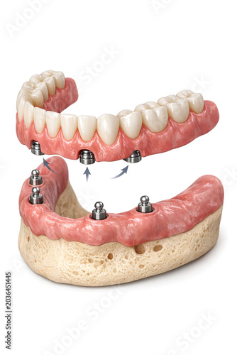 This is a detailed image showing the inside of a mouth with dental implants secured by screws. It provides an informative view of how such procedures are performed.