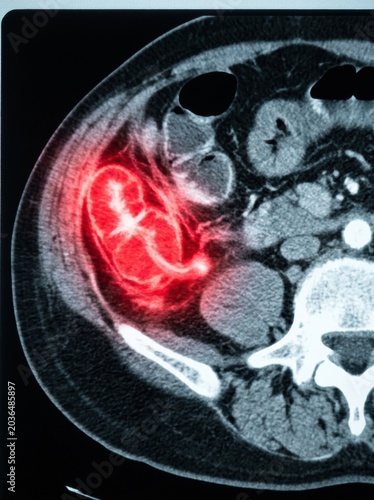 Medical Imaging of Abdominal CT Scan Showing Appendicitis with Highlighted Inflammation