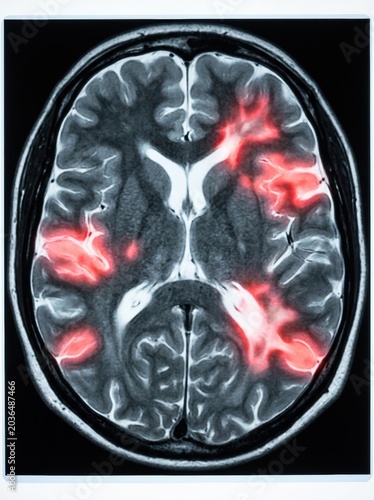 Medical Brain MRI Scan Showing Demyelination and Neurological Damage in a Patient