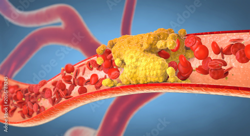Quadro su tela Atherosclerosis is a condition where arteries become narrowed and blocked by fatty plaque buildup