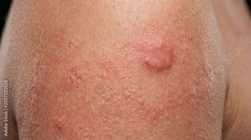 Extreme macro skin rash close up with irritated red hives dermatology medical texture detail