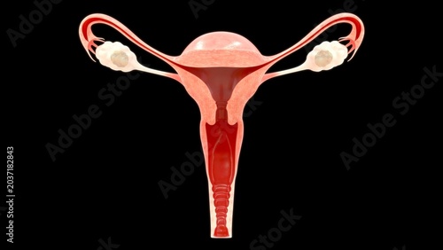 Ovarian Cyst Medical Illustration