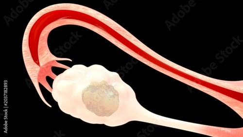 Anatomical Diagram of an Ovarian Mass