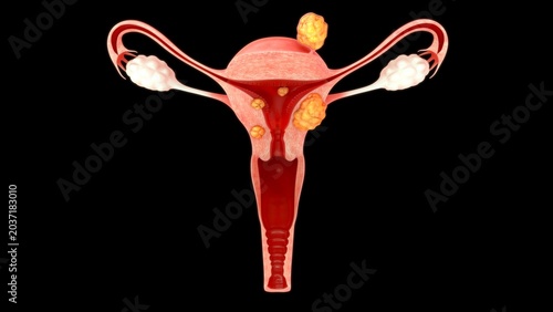 Anatomical Diagram of Multiple Uterine Fibroids
