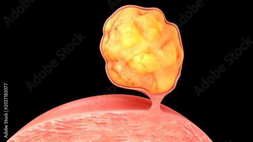 Foto Anatomical Diagram of Multiple Uterine Fibroids