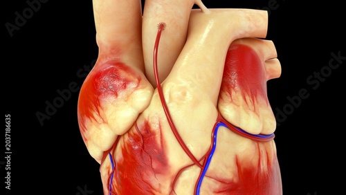 Tableau sur toile Coronary artery bypass grafting (CABG) is a major surgical procedure used to treat severe coronary artery disease
