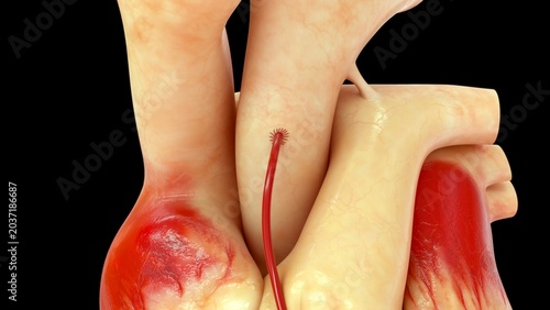 Foto Coronary artery bypass grafting (CABG) is a major surgical procedure used to treat severe coronary artery disease