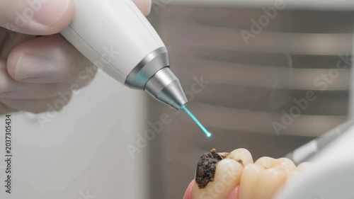 Expert dental professional employs advanced laser to treat tooth decay in a modern clinic setting