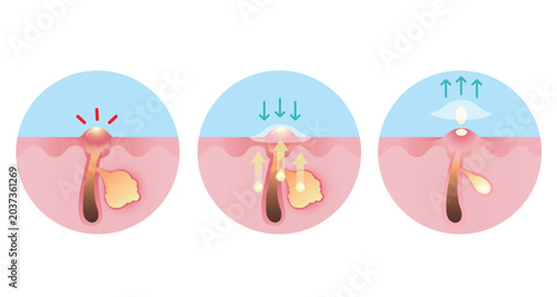 Tableau sur toile How to use zit away patch for inflammatory acne vector icon set illustration on white background