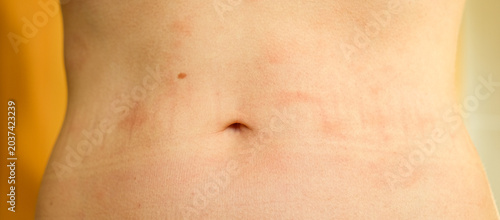 Konstfotografi Atopic dermatitis on the abdominal skin of a woman, severe itching on the side