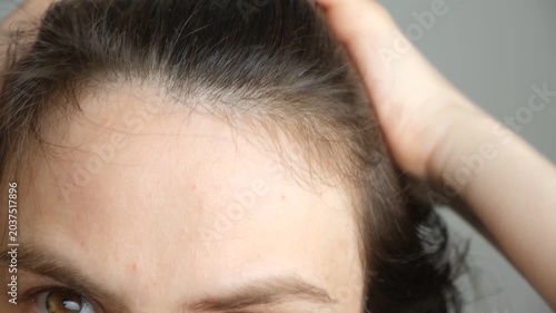 Close-up of new short baby hairs growing on a womans scalp after hair loss treatment.
